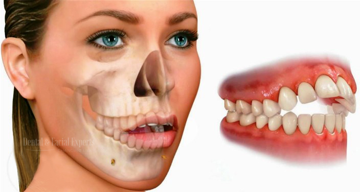 Cirurgia ortognática: antes e depois da cirurgia maxilar